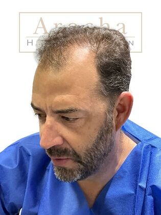 Long Hair FUE: Case 2 - Before