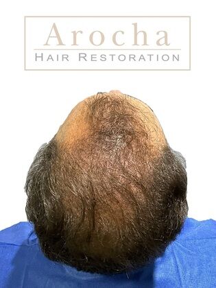 Long Hair FUE: Case 2 - Before