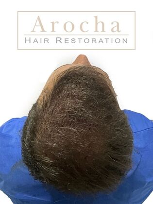 Long Hair FUE: Case 2 - Immediately post-op