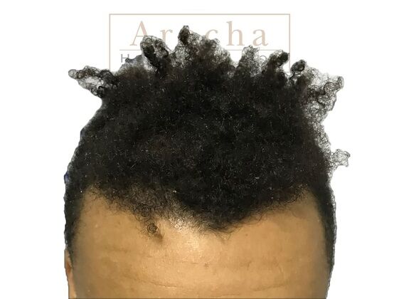 Long Hair FUE: Case 1 - Taken immediately post-op