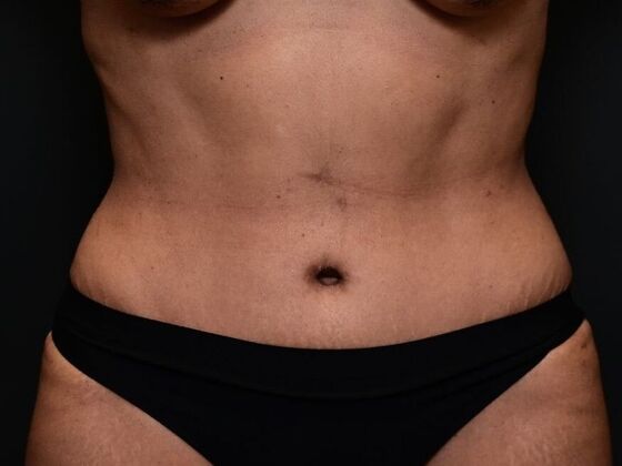 Tummy Tuck with Contouring Case 1 - After