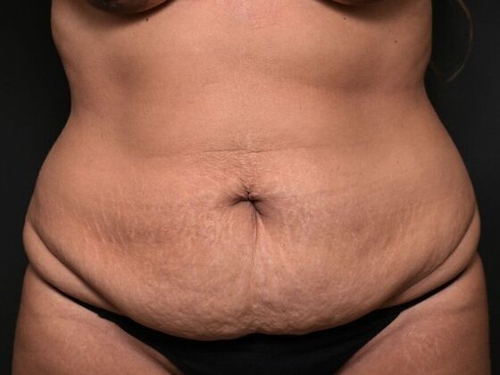 Tummy Tuck with Contouring Case 1 - Before