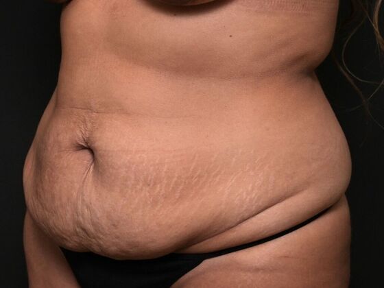 Tummy Tuck with Contouring: Case 1 - Before