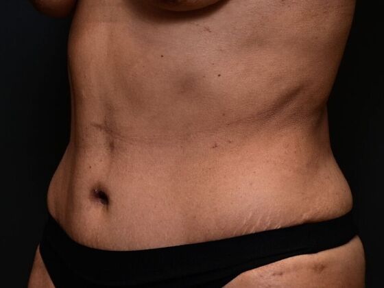 Tummy Tuck with Contouring: Case 1 - After