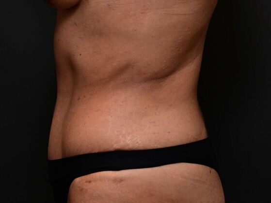 Tummy Tuck with Contouring: Case 1 - After