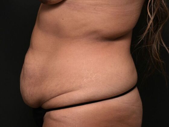 Tummy Tuck with Contouring: Case 1 - Before