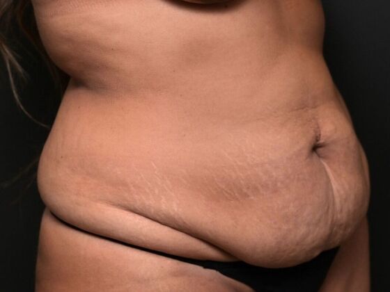 Tummy Tuck with Contouring: Case 1 - Before