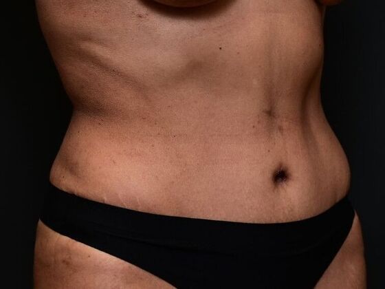 Tummy Tuck with Contouring: Case 1 - After