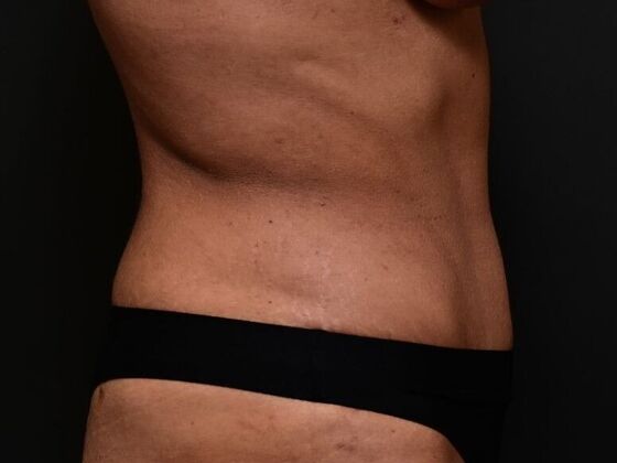 Tummy Tuck with Contouring: Case 1 - After
