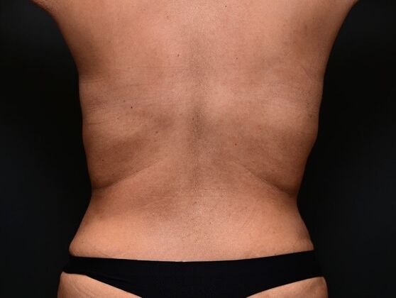 Tummy Tuck with Contouring: Case 1 - After