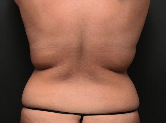 Tummy Tuck with Contouring: Case 1 - Before