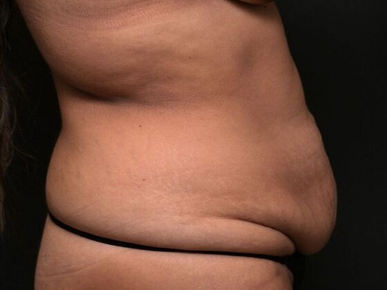 Tummy Tuck with Contouring: Case 1 - Before