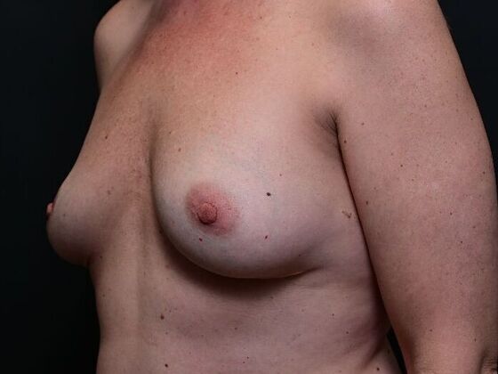 Breast Lift: Case 1 - Before