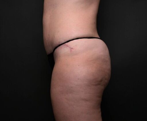 Mommy Makeover: Case 1 - After