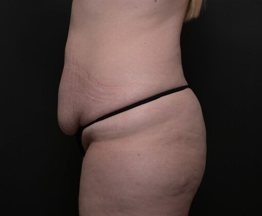 Mommy Makeover: Case 1 - Before