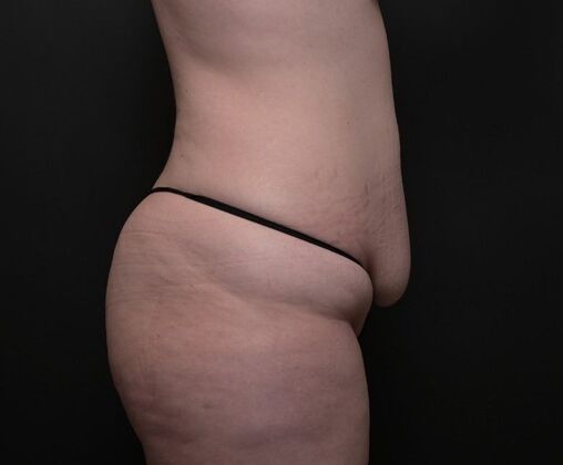 Mommy Makeover: Case 1 - Before