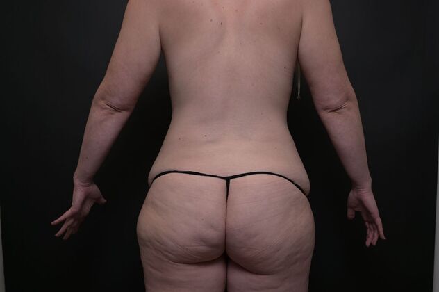 Mommy Makeover: Case 1 - Before