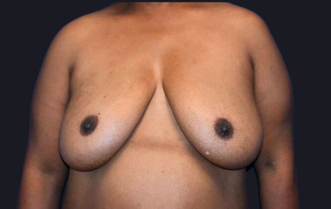 Breast Reconstruction: Case 1 - Before