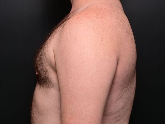Gynecomastia Case 1 - After