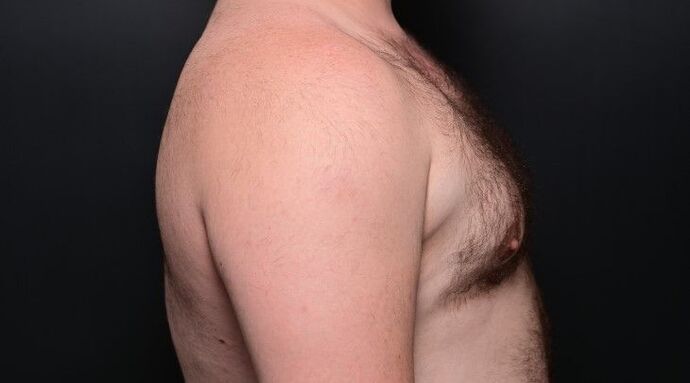 Gynecomastia: Case 1 - After