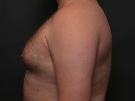 Gynecomastia Case 1 - Before