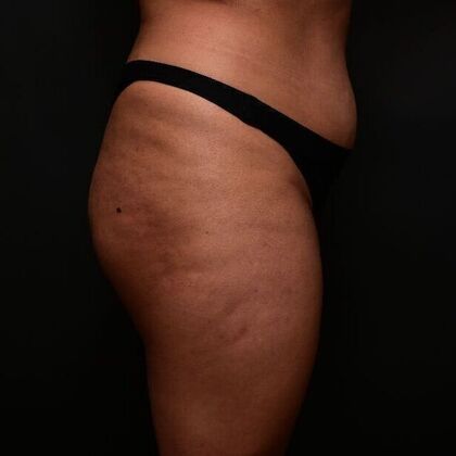 Brazilian Butt Lift: Case 2 - Before