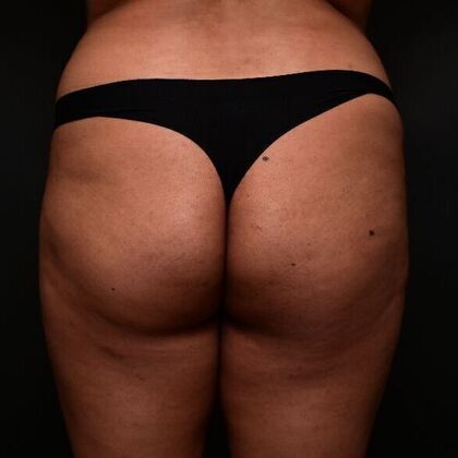 Brazilian Butt Lift Case 2 - Before