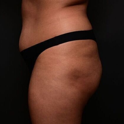 Brazilian Butt Lift: Case 2 - Before