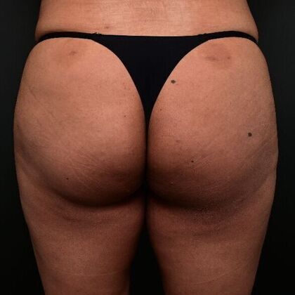 Brazilian Butt Lift Case 2 - After