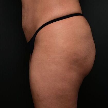 Brazilian Butt Lift: Case 2 - After