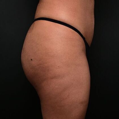 Brazilian Butt Lift: Case 2 - After