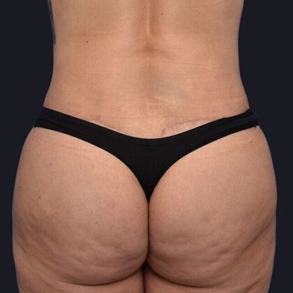 Brazilian Butt Lift Case 3 - After