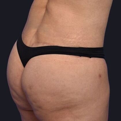 Brazilian Butt Lift: Case 3 - After