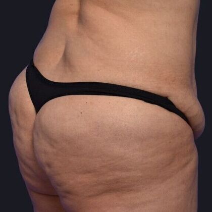 Brazilian Butt Lift: Case 3 - Before