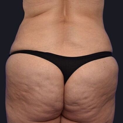 Brazilian Butt Lift Case 3 - Before