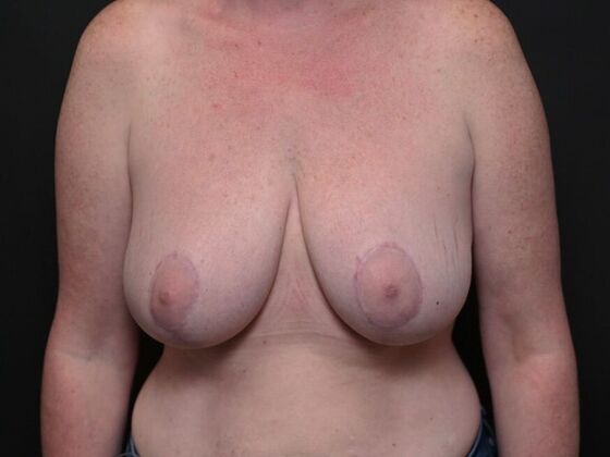 Breast Lift Case 2 - Before