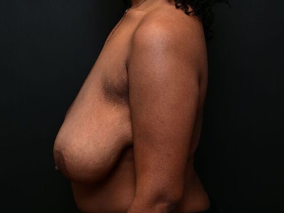 Breast Reduction: Case 2 - Before