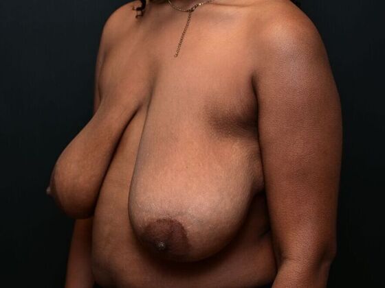 Breast Reduction Case 2 - Before
