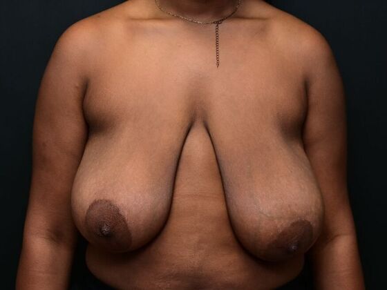 Breast Reduction: Case 2 - Before