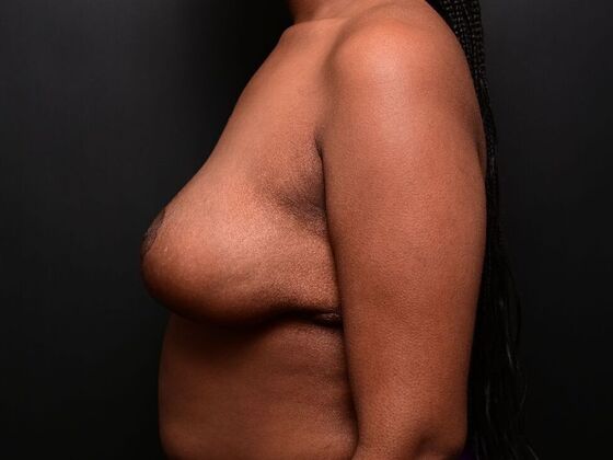 Breast Reduction: Case 2 - After