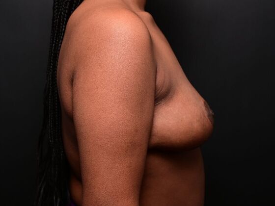 Breast Reduction: Case 2 - Before