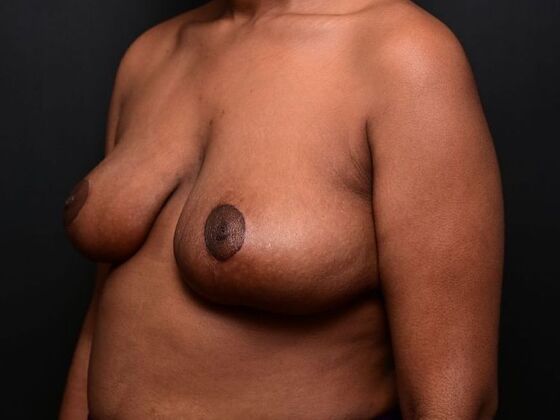 Breast Reduction Case 2 - After