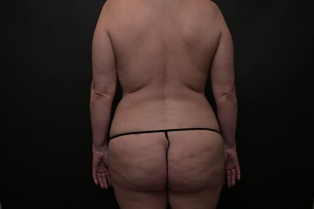 Mommy Makeover: Case 2 - Before