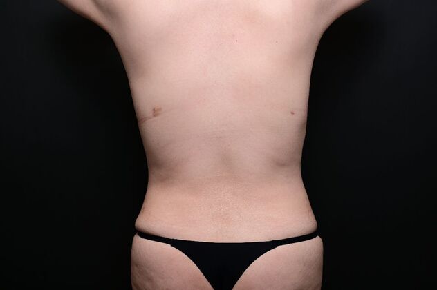 Mommy Makeover: Case 3 - After