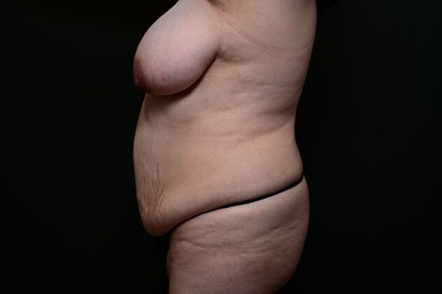 Mommy Makeover Case 3 - Before