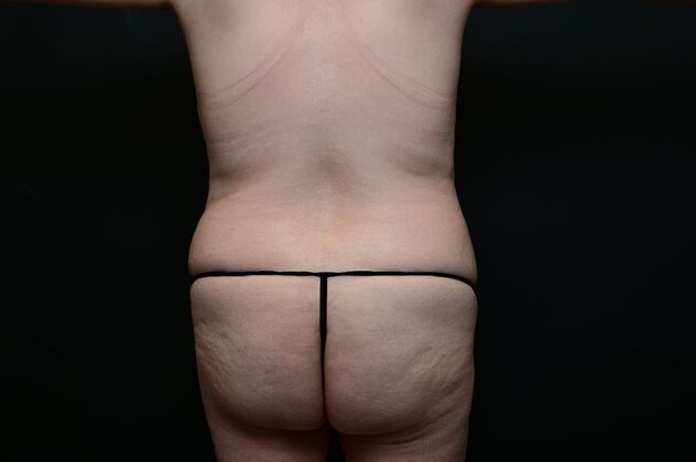 Mommy Makeover: Case 3 - Before