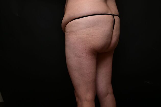 Mommy Makeover: Case 3 - Before