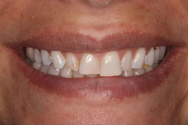 Porcelain Veneers: Michelle - Before