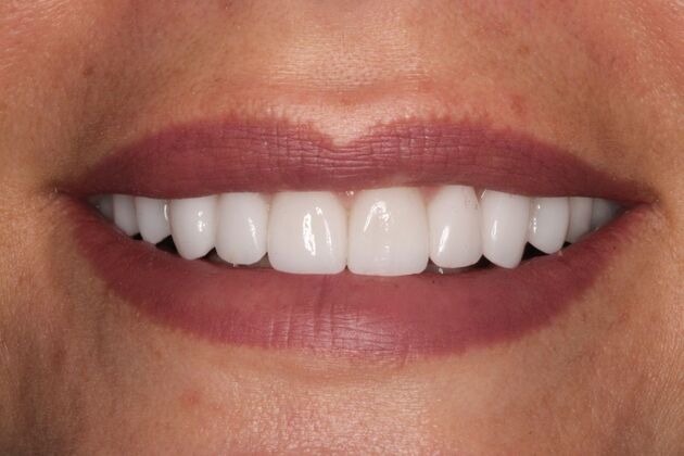 Porcelain Veneers: Michelle - After