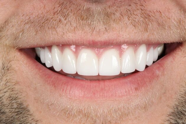 Porcelain Veneers: Zac - After